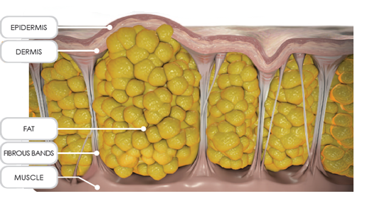 The Definitive Guide for Is Cellulite Forever? - Scientific American thumbnail