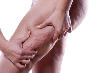 cellulite.jpg